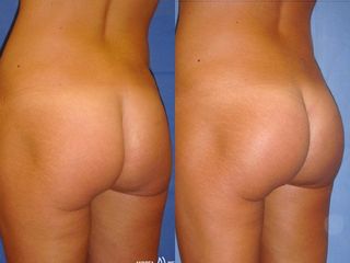 Gluteoplastica prima e dopo