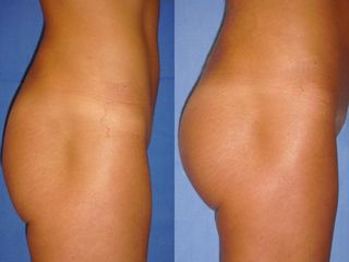 Gluteoplastica prima e dopo