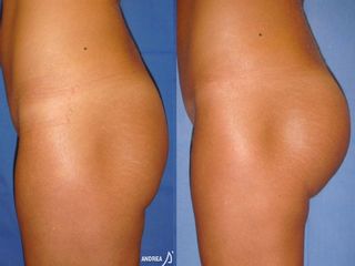 Gluteoplastica prima e dopo