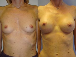 Mastoplastica additiva prima e dopo