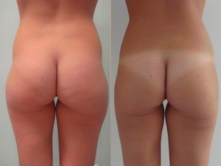 Liposcultura prima e dopo
