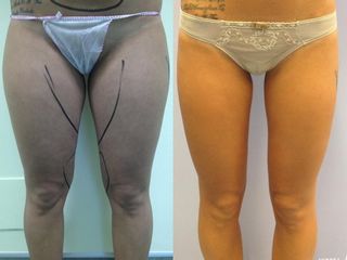 Liposcultura prima e dopo