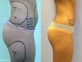 Liposcultura prima e dopo