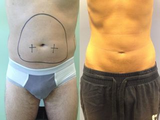 Liposcultura prima e dopo