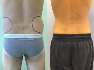 Liposcultura prima e dopo