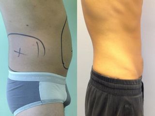 Liposcultura