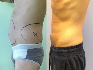 Liposcultura prima e dopo