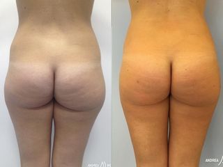 Liposcultura prima e dopo