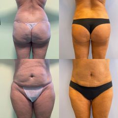 Liposuzione -Dott Mezzoli Andrea