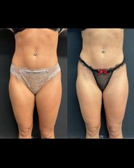 Liposuzione - Dott Mezzoli Andrea