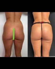 Liposuzione - Dott Mezzoli Andrea