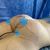 Gluteoplastica +lipofilling a Milano Dott. Ivanildo Tome' De Arruda Filho