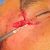 Trattamento cicatrice post traumatica