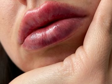 Filler labbra sopra ogni aspettativa a Milano Dr. Luca Zattoni
