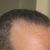 Trapianto di capelli con tecnica FUE: Soddisfatto del Dottore e del Risultato