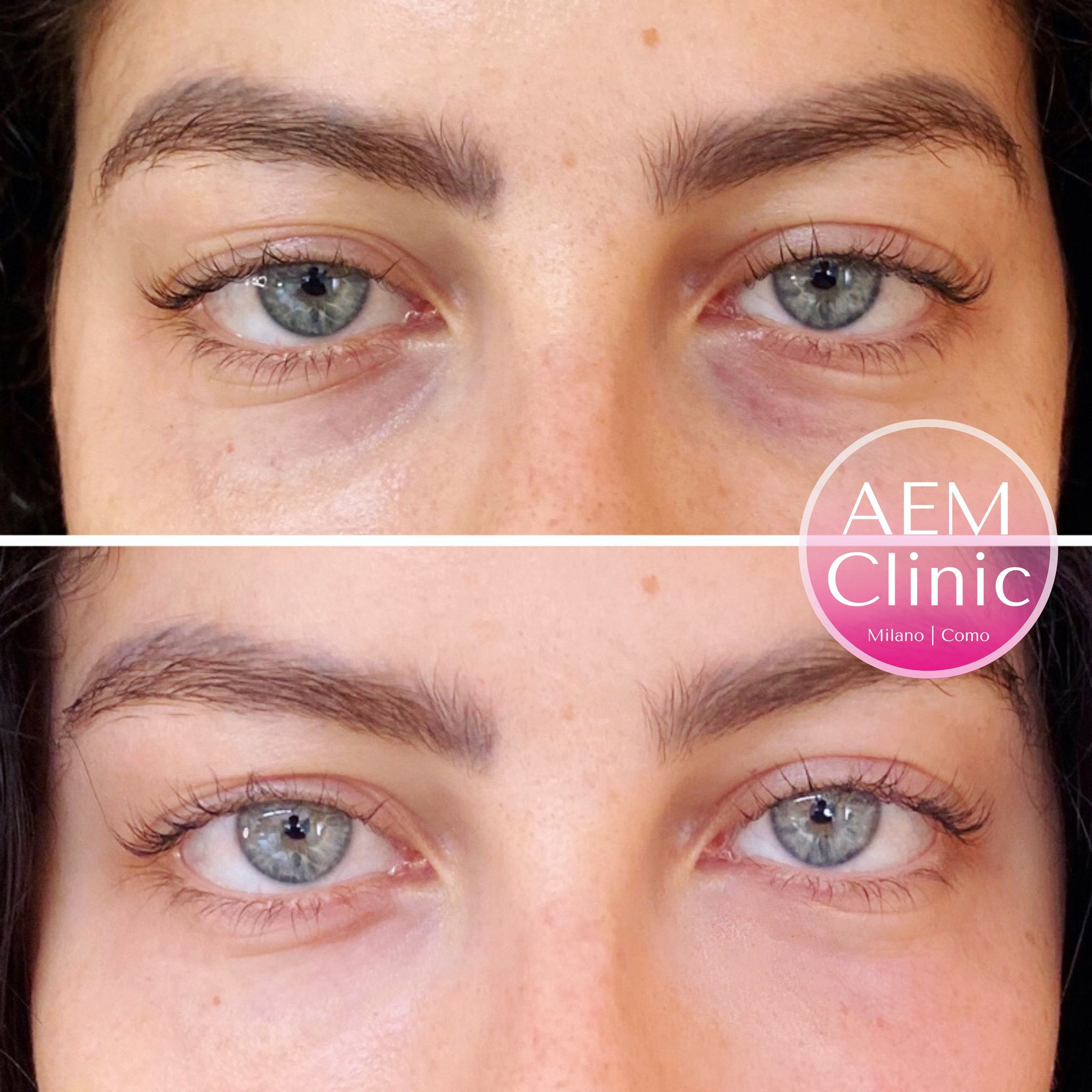 Filler Occhiaie Prima E Dopo filler occhiaie perfetto!! - Filler - Guidaestetica.it