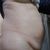 La mini addominoplastica con liposuzione ha risolto molti miei problemi. Ora sto meglio