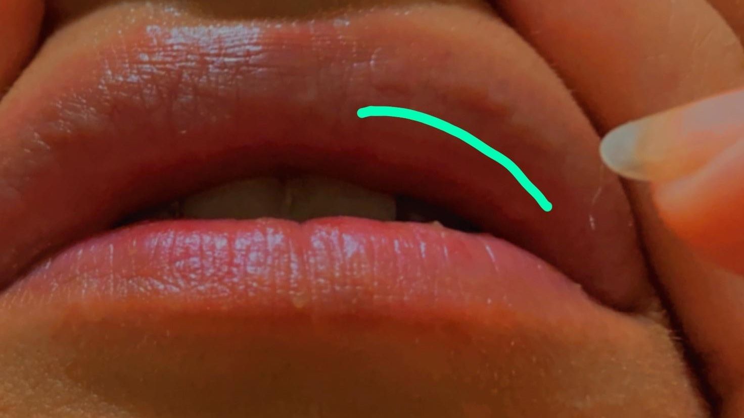 Hyaluron Pen Labbra Prima E Dopo