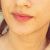Filler labbra e botox con risultati meravigliosi