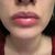 Filler labbra e botox con risultati meravigliosi
