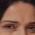 Filler labbra e botox con risultati meravigliosi