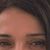 Filler labbra e botox con risultati meravigliosi
