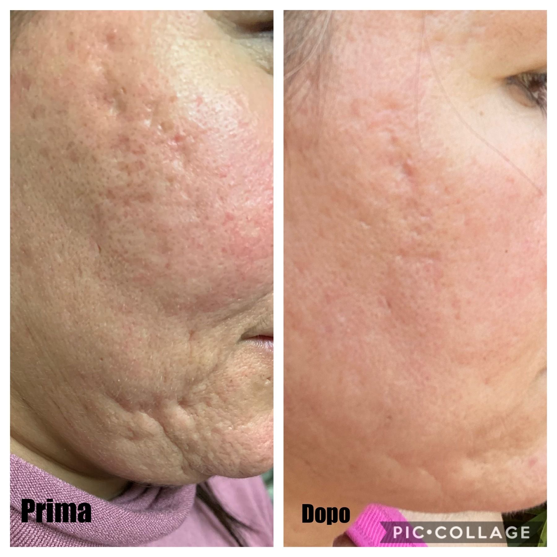 Cicatrici Acne Prima E Dopo Microneedling per cicatrici dovute all’acne - Cicatrici - Guidaestetica.it