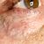 Ho rimosso un antiestetico fibroma pendulo sotto all’occhio