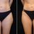 Criolipolisi Centro Skintastic Busto Arsizio.