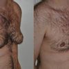 Trattamento di correzione di ginecomastia vera