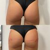 Filler glutei a Lecco con il dottor Zattoni