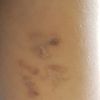 Dopo 6 sedute è rimasto un tatuaggio fantasma?