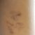 Dopo 6 sedute è rimasto un tatuaggio fantasma?