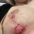 DEISCENZA POST OPERAZIONE