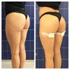 Gluteoplastica non Chirurgica con Los Deline