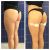 Gluteoplastica non Chirurgica con Los Deline