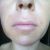 Labbra sottili: il riempimento con acido iaulironico mi ha cambiato il viso