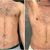 Epilazione laser