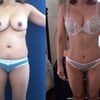 Chirurgia estetica italiana o internazionale? - Mommy makeover
