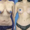 Chirurgia estetica italiana o internazionale? - Mommy makeover