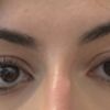 Asimmetria occhi- blefaroplastica/ cantoplessi