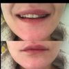 Filler labbra con acido ialuronico - reazioni post trattamento 