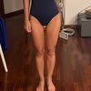 Rimodellamento gambe con liposuzione
