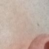 Rimozione del tubercolo di Darwin