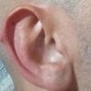 Rimozione del tubercolo di Darwin