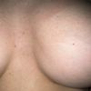 Mastoplastica additiva realizzata 4 mesi fa