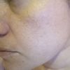 Trattamento pelle viso per pori dilatati e macchie