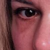 Occhi scavati e occhiaia dopo blefaroplastica
