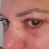 Occhi scavati e occhiaia dopo blefaroplastica