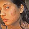 Come eliminare per sempre le cicatrici da acne